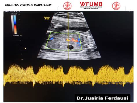 Ultrasound the Best #16: Ductus Venosus Waveform – WFUMB