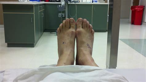 All About Morton's Neuroma: Surgery & Recovery