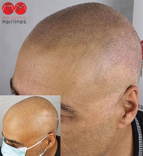 Scalp Micropigmentation Aftercare Guidelines - International Hairlines