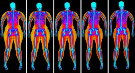 DEXA BODY COMPOSITION ANALYSIS - BGSA Radiology