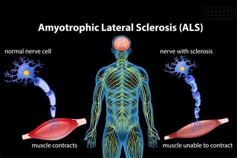 ALS Symptoms, Stages and Progression - Lone Star Neurology