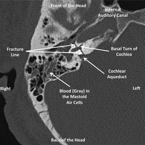 Axial (horizontal) CT of the right temporal bone showing a fracture ...