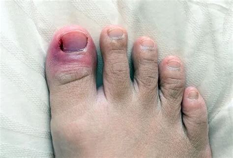 Infected Nail (Paronychia): Treatment, Symptoms & Pictures