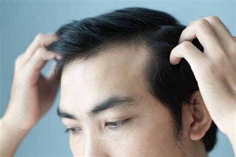 Receding Hairline In Men – Treatments To Restore Hair Growth