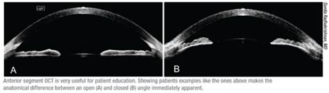 Making the Most of Anterior Segment OCT