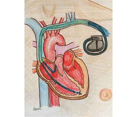 Hypertrophic Obstructive Cardiomyopathy (HOCM) - Symptoms, ECG, Murmur & Treatment