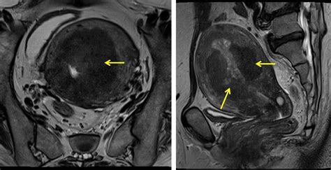 Endometrial endometrioid carcinoma – Radiology Cases