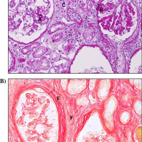 Kidney biopsy. A) PAS staining. Histology of the kidney with... | Download Scientific Diagram