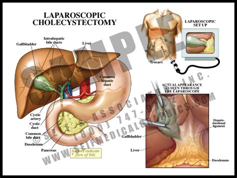 Laparoscopic Cholecystectomy Anatomy