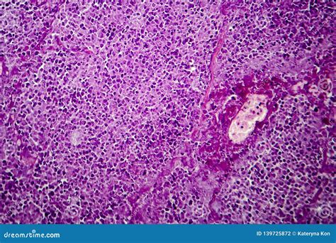 Caseation of Human Tuberculosis Granuloma, Light Micrograph Stock Photo ...