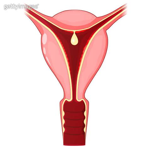 Uterine polyp. Human uterus with Endometrial polyp 이미지 (1424338612 ...