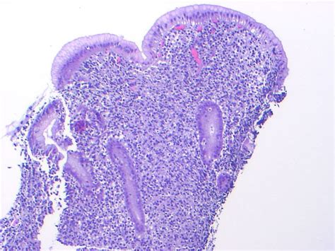 Pathology Outlines - Extranodal marginal zone lymphoma of mucosal associated lymphoid tissue ...