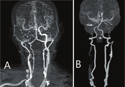 CT angiography (CTA) demonstrates severe carotid artery occlusion... | Download Scientific Diagram