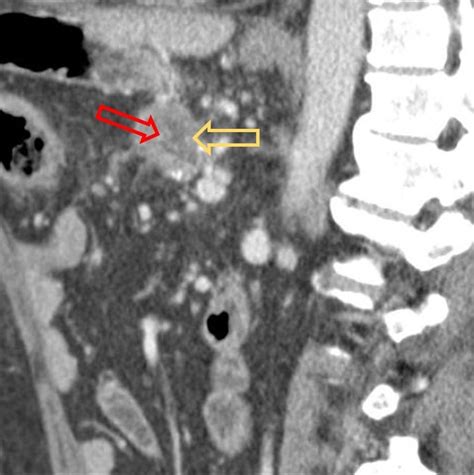 Frey procedure | Image | Radiopaedia.org