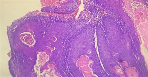 b: Photomicrograph showing extensive keratinization and keratin pearls... | Download Scientific ...