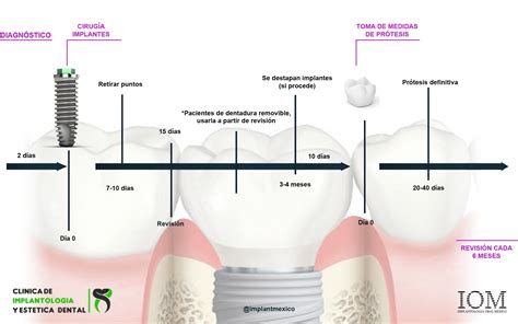 Fase del tratamiento de implantes dentales @implantmexico | Implantes ...