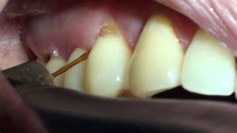 Subgingival Calculus