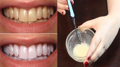 What Is The Best Method For Whitening Teeth - TeethWalls