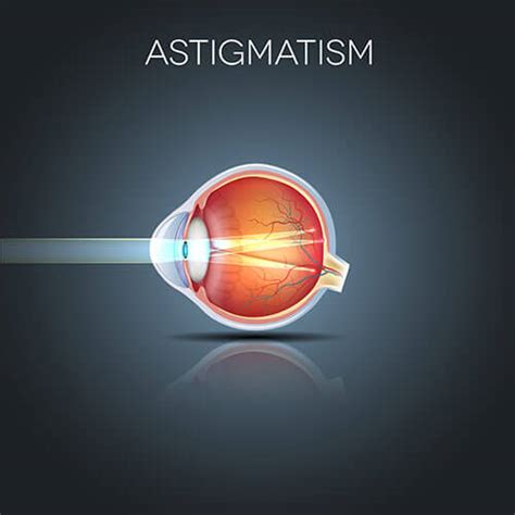 Chart Illustrating How Astigmatism Affects an Eye