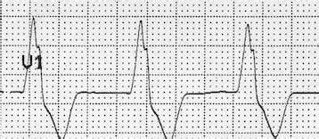 Idioventricular Rhythm Signs And Symptoms Factory Sale | www.jkuat.ac.ke