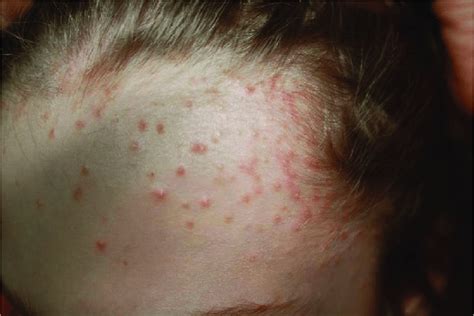 Clobetasol propionate shampoo-induced acne in a 14-year-old girl with ...