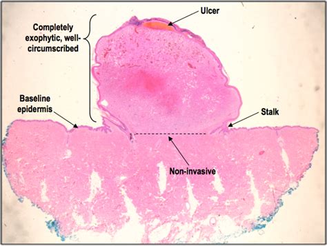 HistoQuarterly: PYOGENIC GRANULOMA | Histology Blog