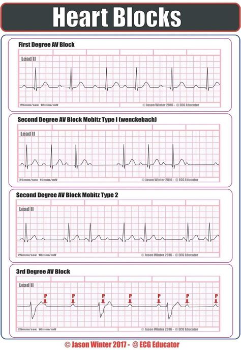 Pin by Pittsburgh Princess on ekg | Ekg nursing, Cardiac nursing, Icu nursing