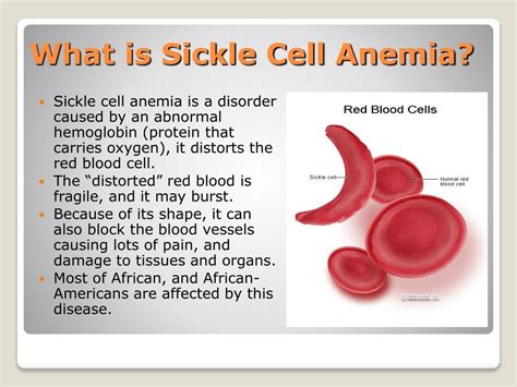 PPT - Sickle Cell Anemia PowerPoint Presentation, free download - ID:3297294