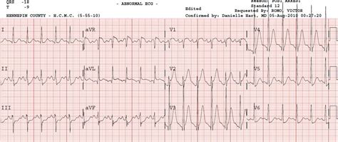 Dr. Smith's ECG Blog: Anterior Hyperacute T-waves diagnostic of LAD Occlusion