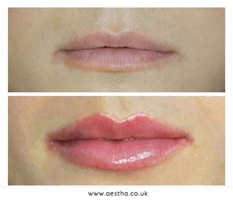 5 Most Common Lip Problems | Aestha Clinic