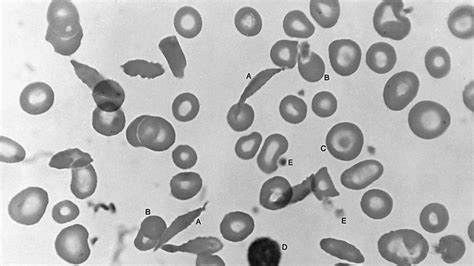 Sickle cell anemia | Symptoms, Sickle Cell Trait, & Treatment | Britannica