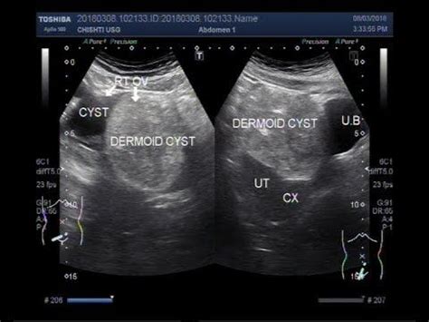 MEDICAL SCHOOL: MEDICAL ULTRASOUND/DERMOID CYST | Dermoid cyst, Medical ultrasound, Cysts