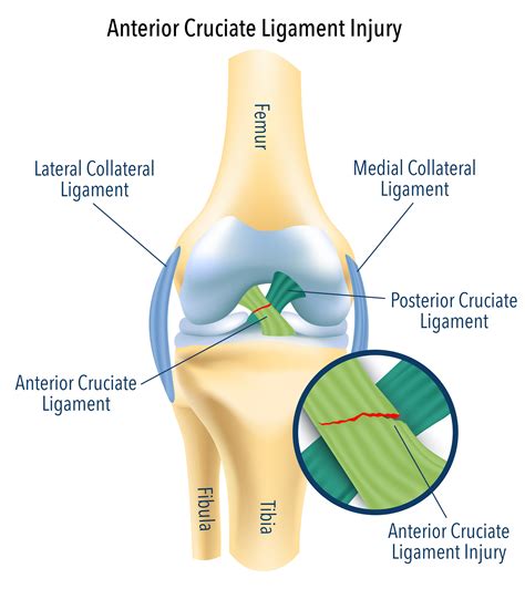 Anterior Cruciate Ligament Surgery | Anterior Cruciate Ligament Injury Treatment