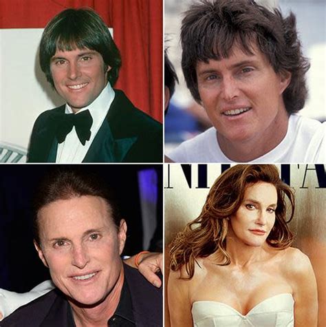 Caitlyn Jenner's New Face: The Physical — and Emotional — Effects of Facial Feminizing Surgery