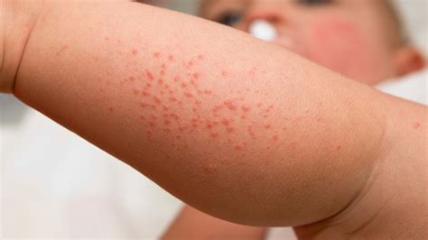 Heat Rash, Prickly Heat (Miliaria) | What to Expect