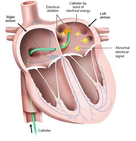 What happens during cardiac ablation? | informedhealth.org