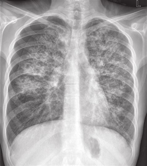 -Chest X-ray showing bilateral pneumothorax and bilateral interstitial ...