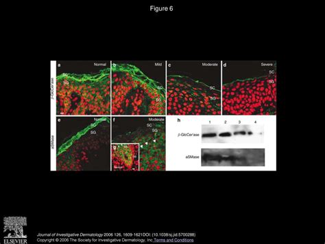 Serine Protease Activity and Residual LEKTI Expression Determine Phenotype in Netherton Syndrome ...