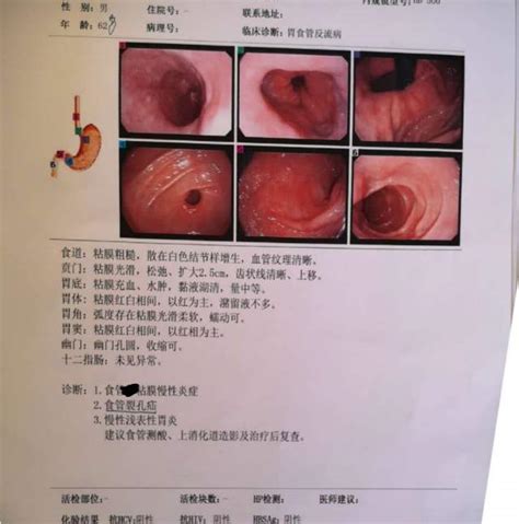 食管裂孔疝分型,食管裂孔疝胃镜图片_大山谷图库