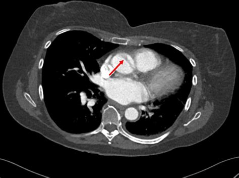 Incidental finding of type A aortic dissection and treated with a CT ...