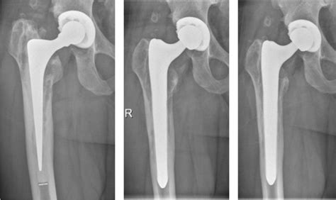 This figure shows a patient with aseptic loosening of a cemented stem ...