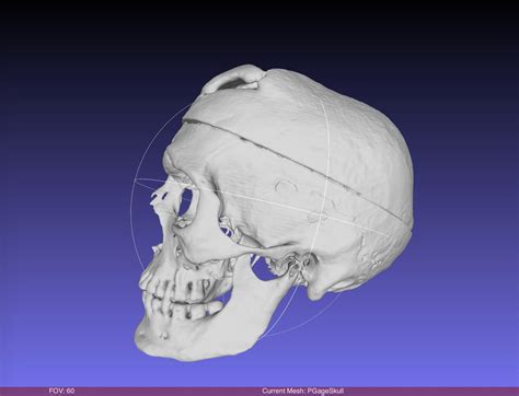 Phineas Gage Skull, harvard CT SCAN, Museum Quality High Resolution STL ...