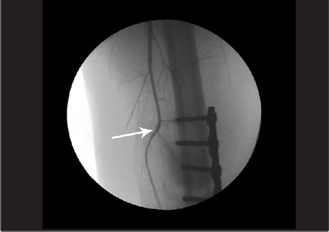 Figure 1 from Management of Iatrogenic Rupture of Profunda Femoris Artery after Femoral Fracture ...