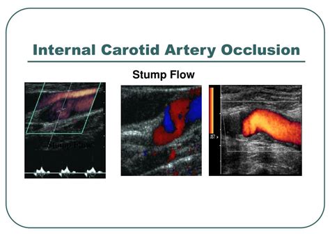 PPT - Carotid Pathology PowerPoint Presentation - ID:462992