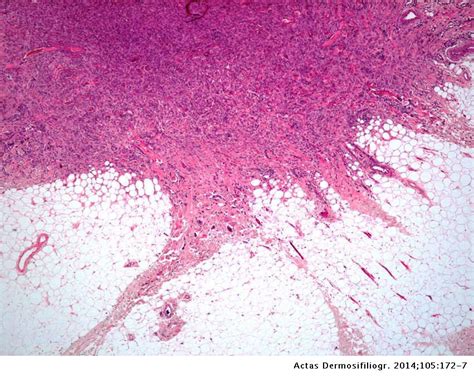 Dermatofibroma of the Face: A Clinicopathologic Study of 20 Cases | Actas Dermo-Sifiliográficas