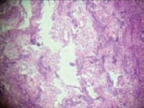 Photomicrograph showing calcified tissue and fibrous tissue. | Download Scientific Diagram