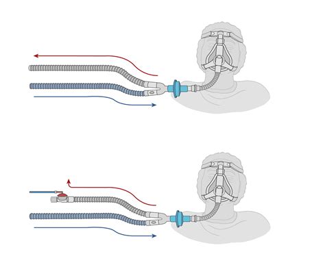 Dual limb non-invasive ventilation circuit types - Open Critical Care