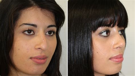 Rhinoplasty Surgery in Sydney, NSW | Dr Miroshnik