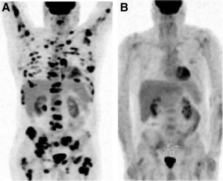 In Newly Diagnosed Diffuse Large B-Cell Lymphoma, Determination of Bone ...