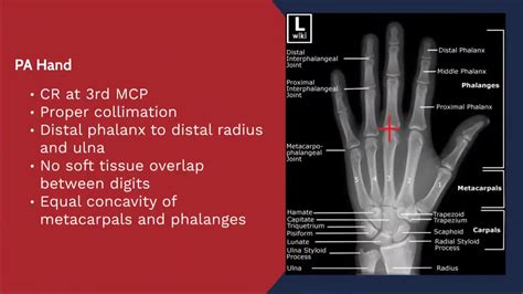 X-ray Positioning Evaluation - PA Hand - YouTube